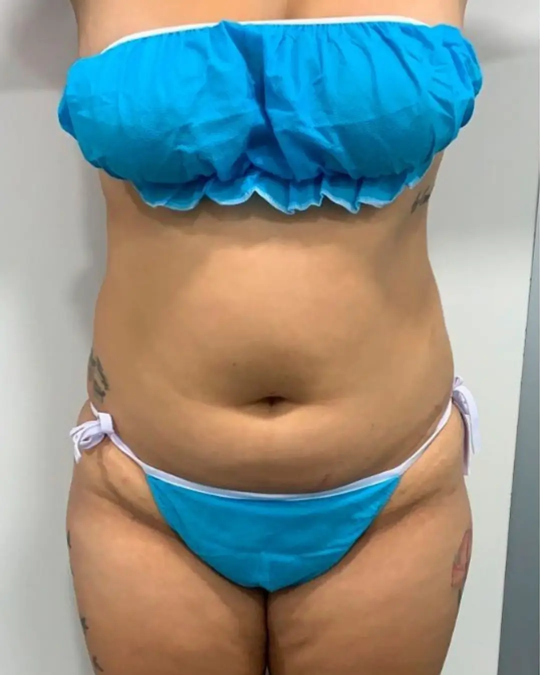 Antes — Hidrolipoescultura resultado 2 — Pura Estética Cancún