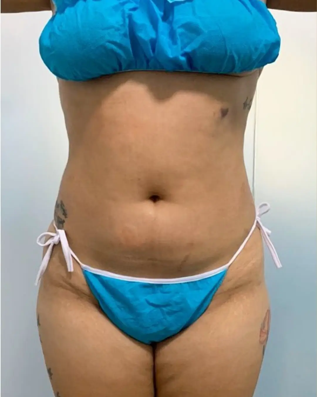 Después — Hidrolipoescultura resultado 2 — Pura Estética Cancún