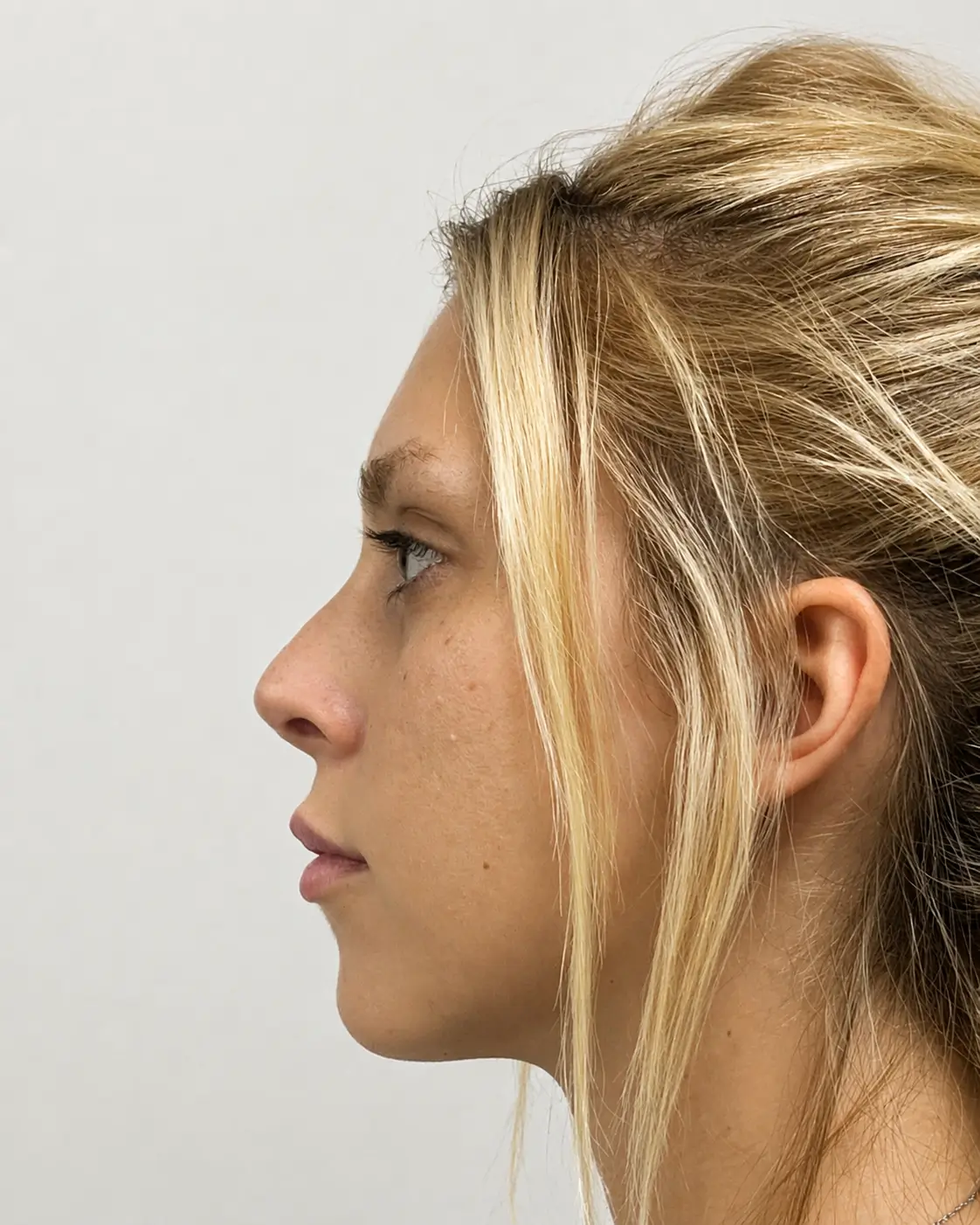Antes — Rinolips — Pura Estética Cancún