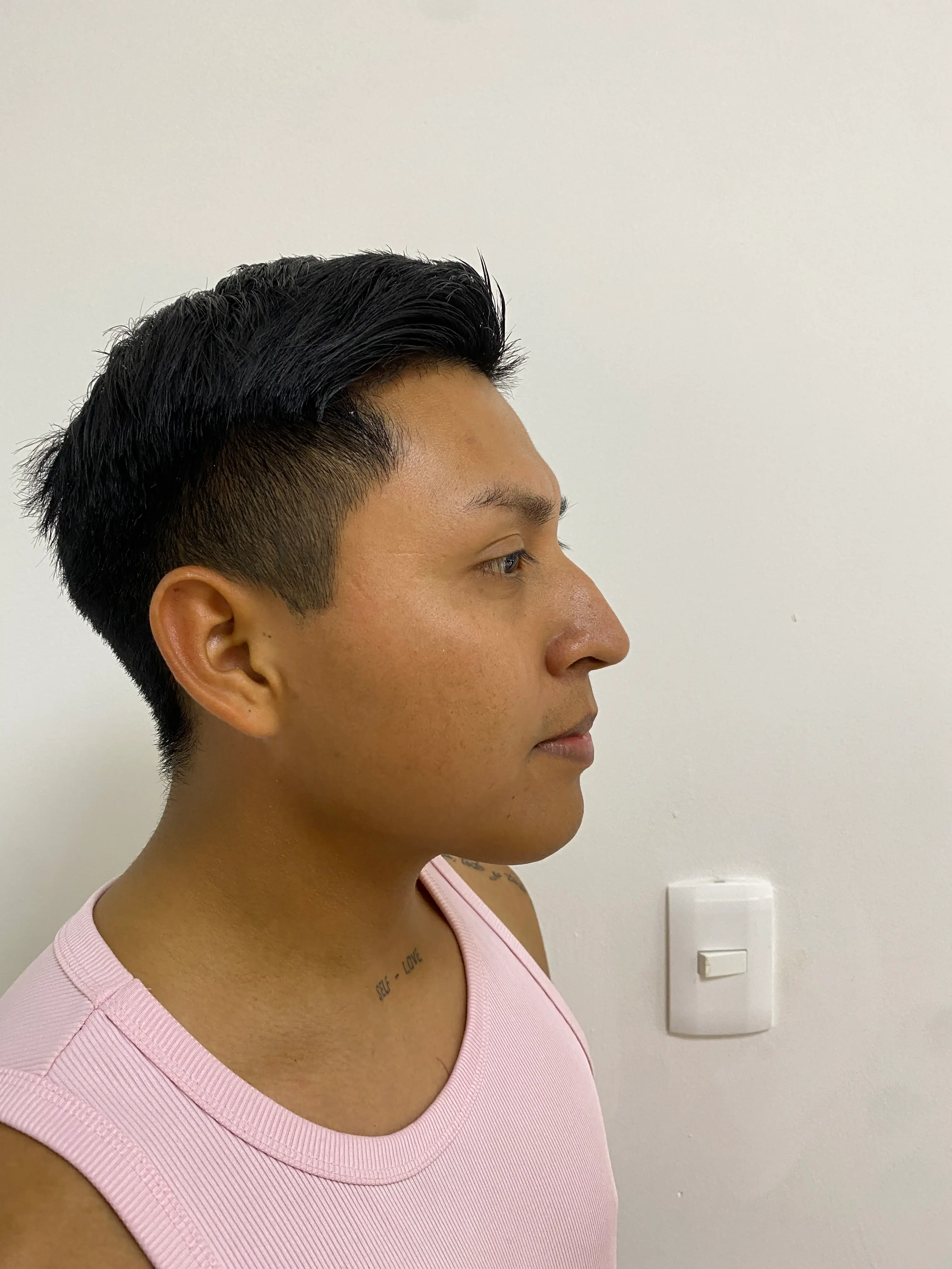 Antes — Rinomodelación resultado 2 — Pura Estética Cancún