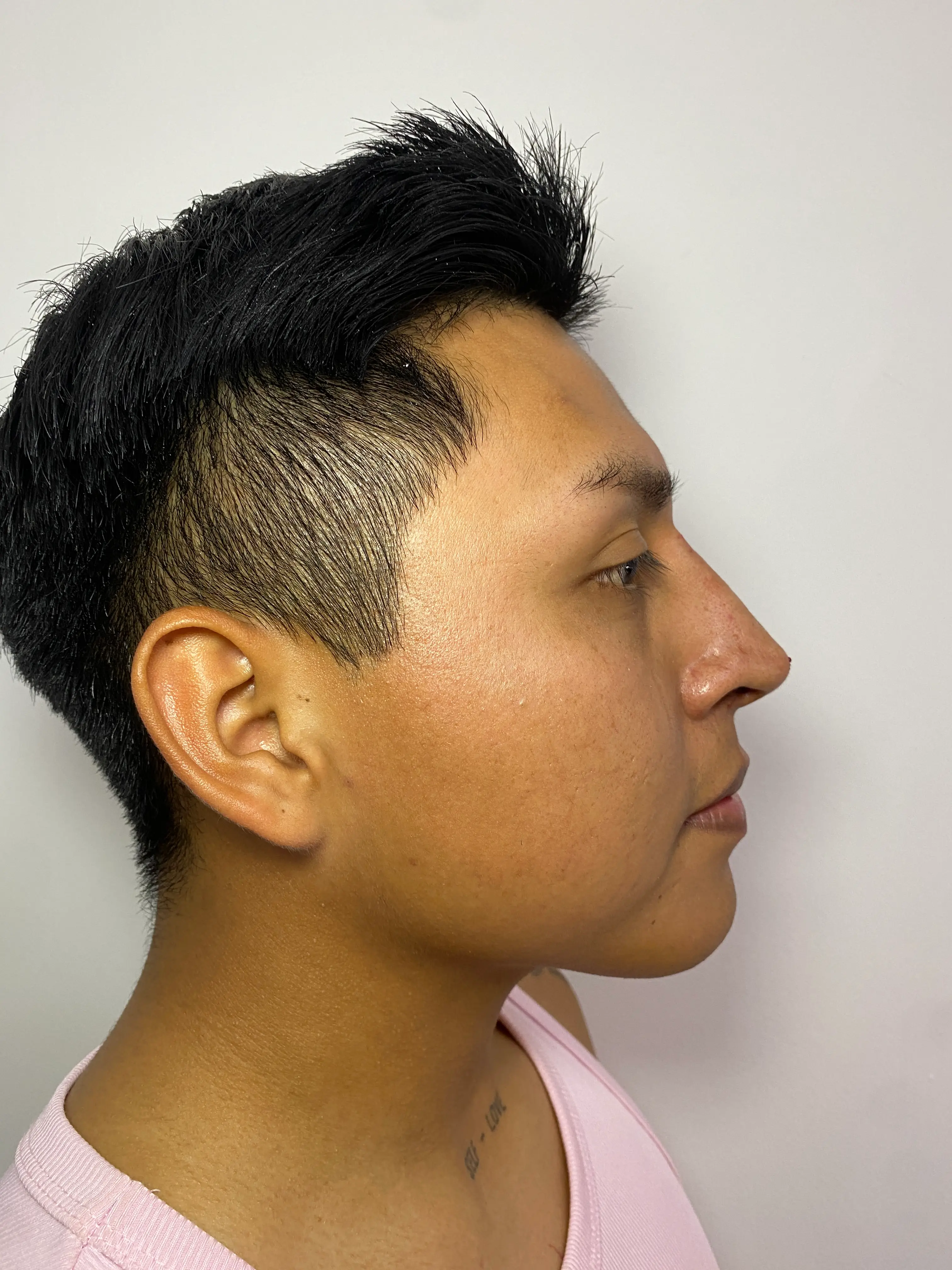 Después — Rinomodelación resultado 2 — Pura Estética Cancún
