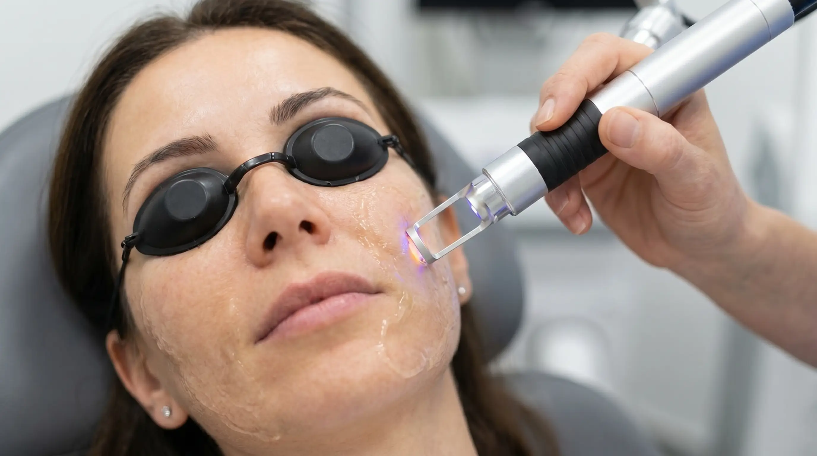 Láser CO2 para reducción de cicatrices y marcas de acné en Cancún — Pura Estética